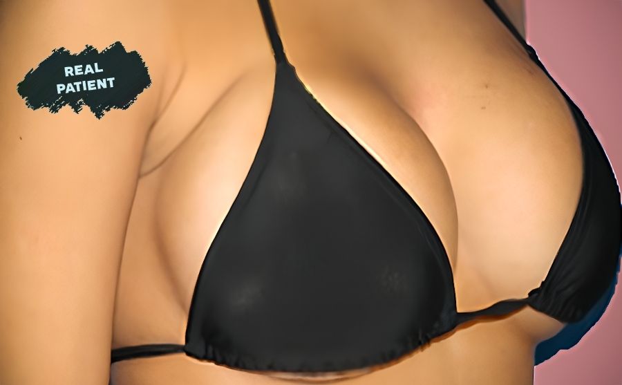 breast-implant-media-content-4