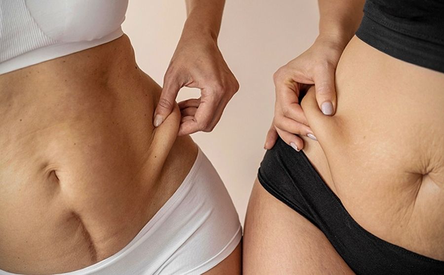 post-bariatric-surgery-media-content-2